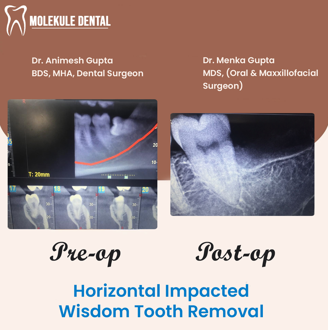 Horizontal Impacted 3rd Molar